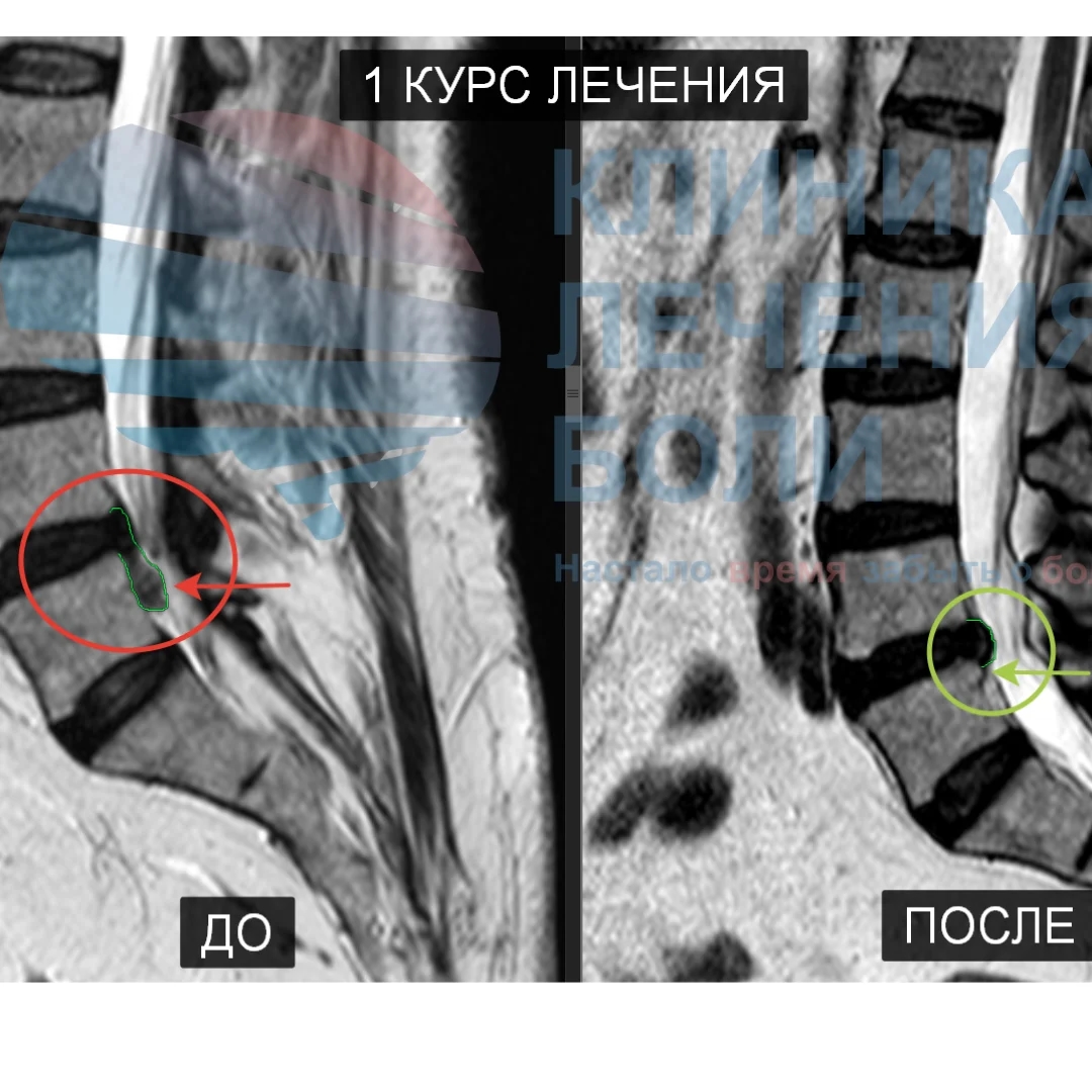 Кейс из практики. Грыжа на уровне L4-L5 